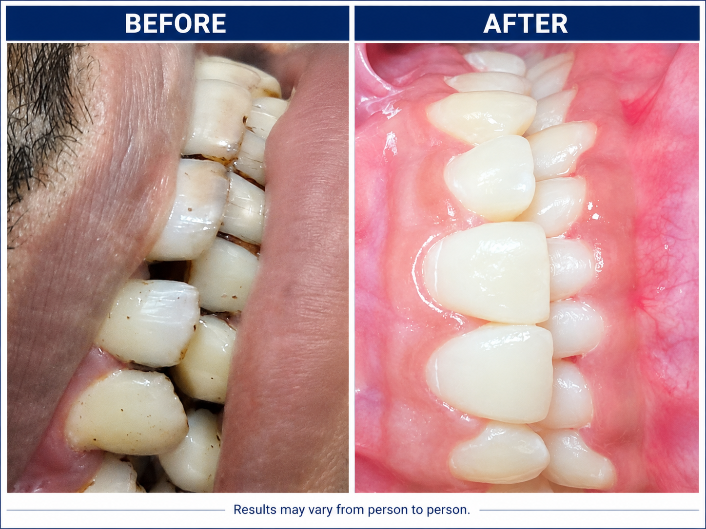 Before and after — Scaling, Polishing & Whitening