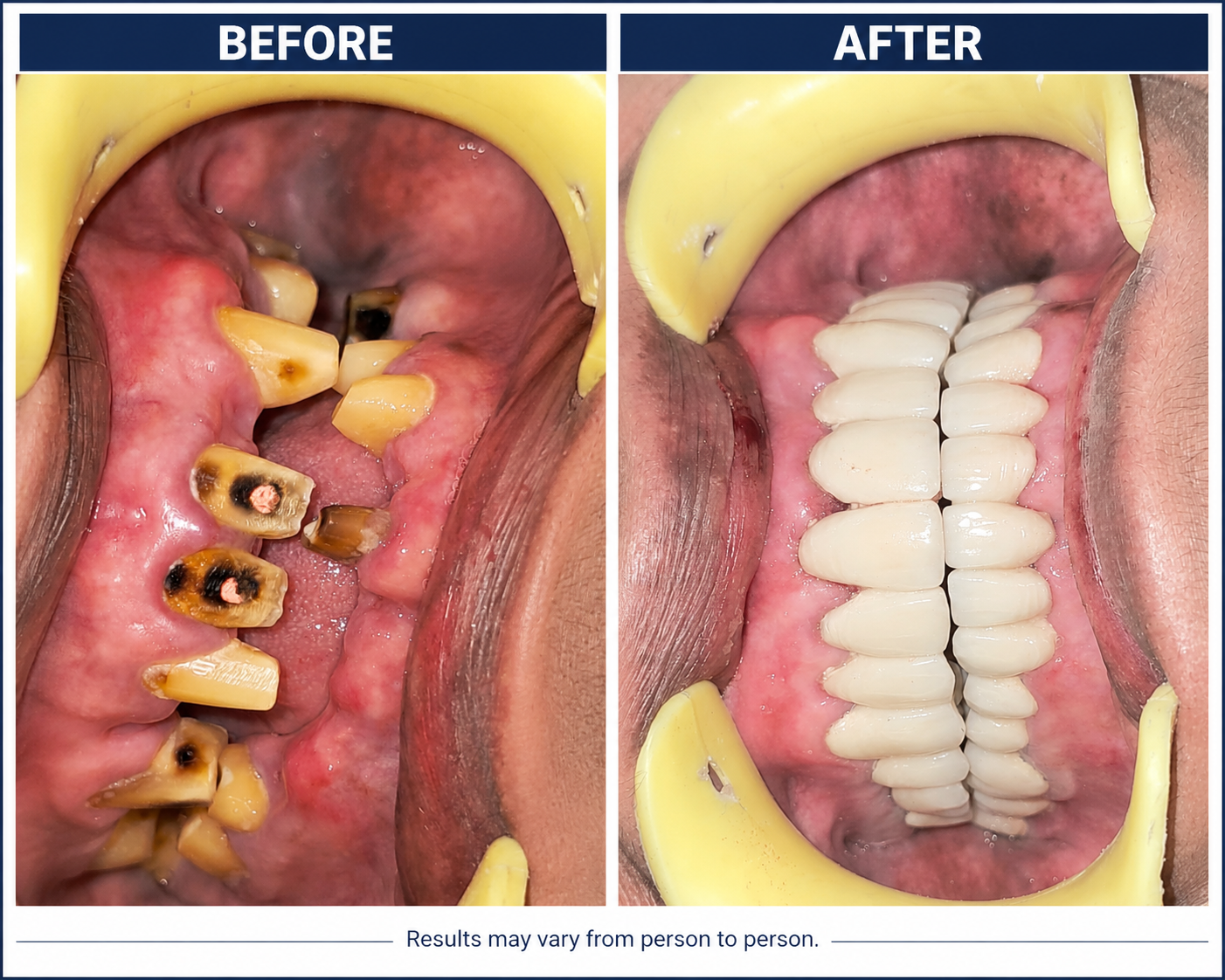 Before and after — Full Mouth Rehabilitation